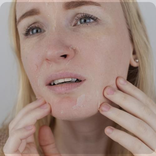 Dry & Dehydrated Skin