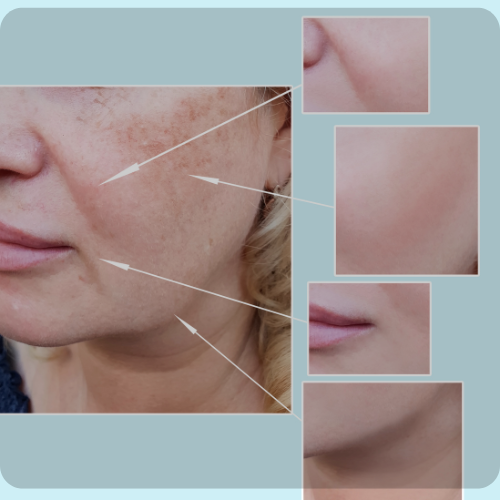 Pigmentation